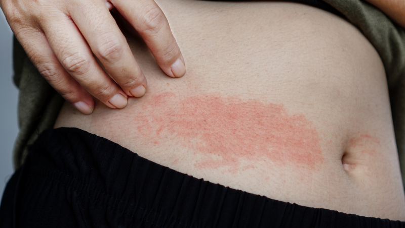 allergic-disorders-treatment-in-sinhgad-road